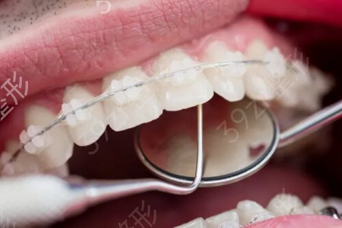 安康市中心医院整形外科牙齿矫正案例：