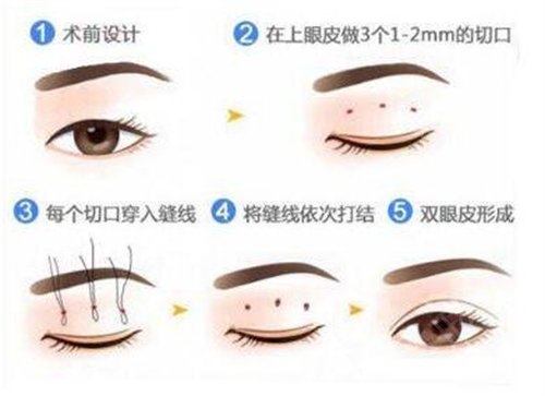 中国人民解放军第九四医院整形外科双眼皮案例：