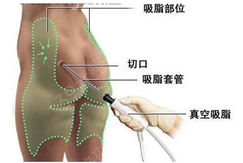 陕西中医药大学附属医院整形外科大腿吸脂案例：