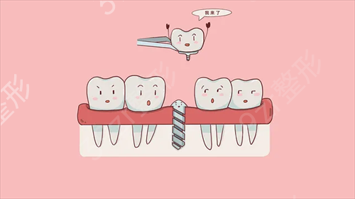 天津医科大学口腔医院口腔颌面外科牙齿种植案例