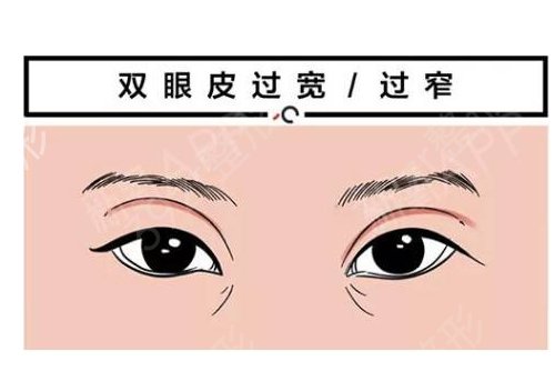 惠州市中心人民医院双眼皮案例