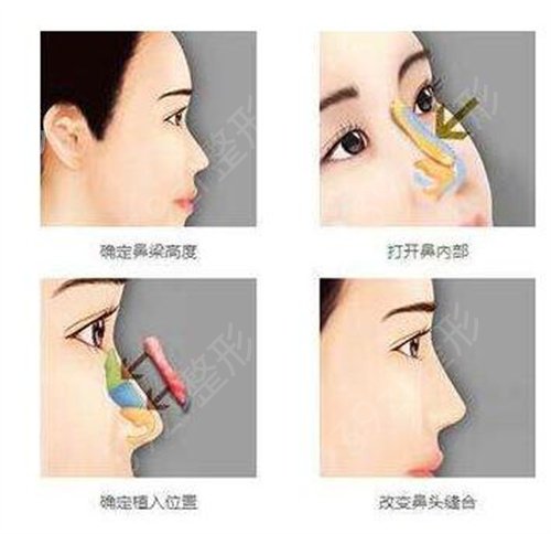 襄阳市第一人民医院整形美容科隆鼻案例