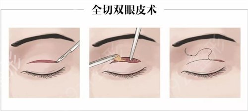 广西医科大学第一附属医院整形美容外科全切双眼皮案例：