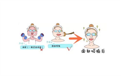 本溪元辰面部吸脂案例