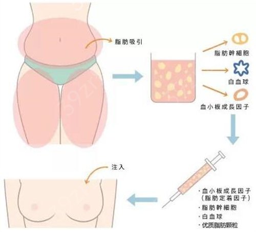 合肥艺星医疗美容医院自体脂肪隆胸案例：