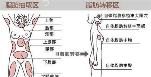 河北涿州市医院整形外科自体脂肪隆胸案例：