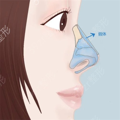 河北涿州市医院整形外科*案例：