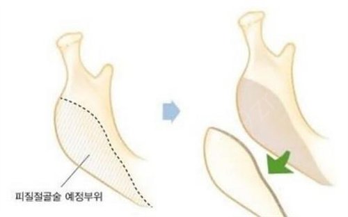 北京处章庆国医生下颌角整形案例：