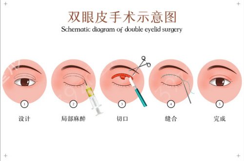 北京301医院整形外科李桂珍医生双眼皮案例：