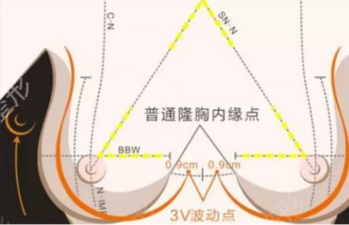 北京301医院郭伶俐医生自体脂肪隆胸案例：