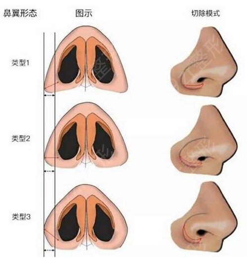 上海仁济医院整形科医生名单|价格表|鼻翼缩小案例展示