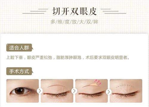 江苏省中医院整形科黄金龙双眼皮*果咋样?图|价格表公开