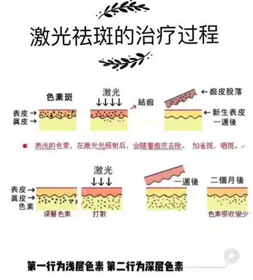 中国人民解放军第303医院整形外科激光祛斑案例：