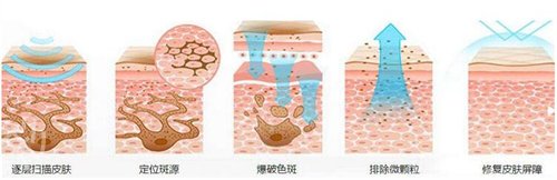 广西国际壮医医院激光美容科激光祛斑案例：