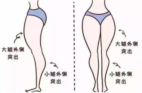青岛市即墨区人民医院整形美容科吸脂瘦大腿案例