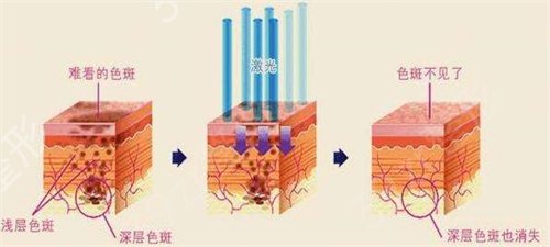 吉林市铁路医院美容科祛斑案例