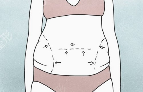 江苏施尔美整形医院吸脂瘦腰腹一个月的恢复记录