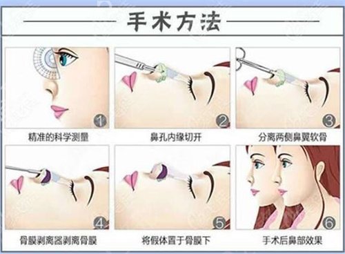 长沙亚韩医学美容医院价格表，附歪鼻矫正隆鼻案例图！