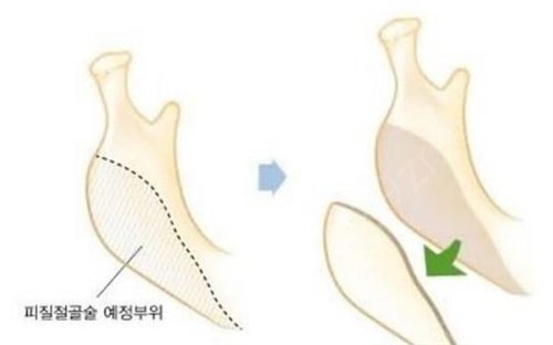 九江市第一人民医院整形科下颌角磨骨案例展示，*果尽显真实实力