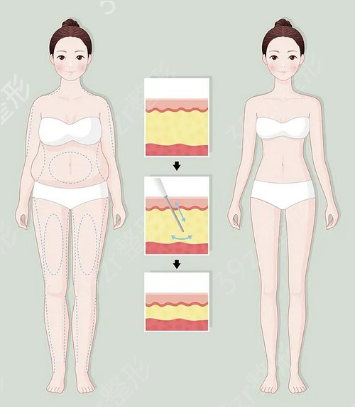安徽省立医院整形科吸脂手术怎么样？看看腰腹吸脂案例*果：重返少女身材！