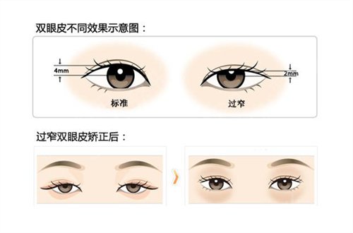 山东省眼科医院割双眼皮案例，2020整形价格表曝光