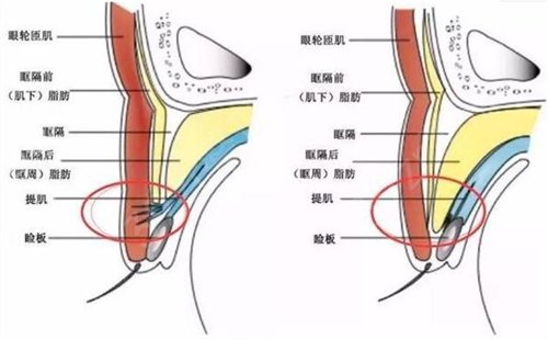 邯郸市中心医院整形科做双眼皮咋样?*果真实闭眼*