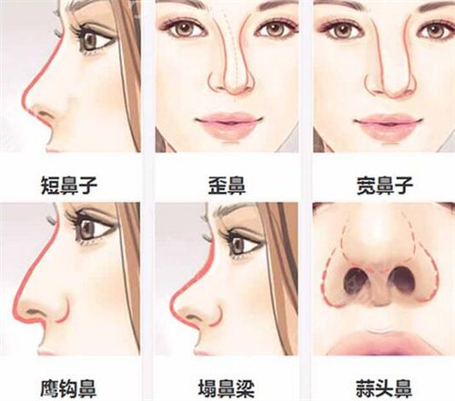鼻头缩小手术图展示