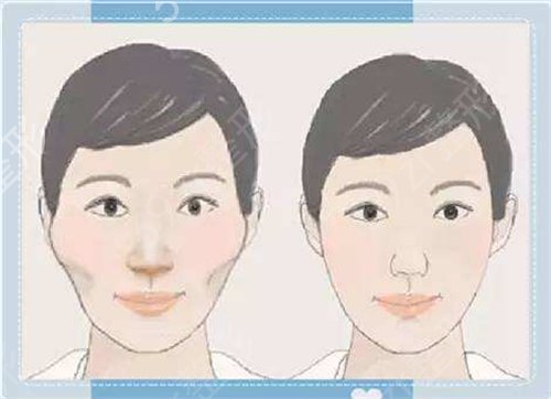 女人后缩下颌角整形外貌变化大不大?