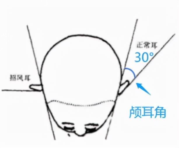 在北京煤炭总医院整形美容科做了耳软骨*，三个月的恢复全记录