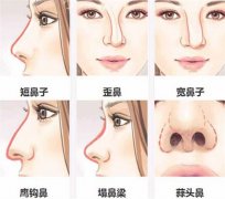 鼻尖抬高手术具体是怎样的？果自然吗？
