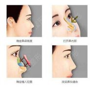 鼻梁歪整形手术方法有哪些？矫正还能治好鼻塞？