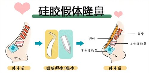 广州可玫尔艺美医疗美容整形医院做的硅胶隆鼻经验分享