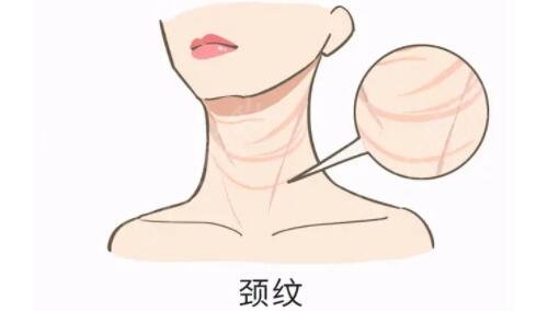 颈部除皱的方法，你中意哪种?