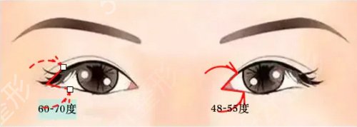 双眼皮微创整形*果能管多长时间？那些眼型适合做？