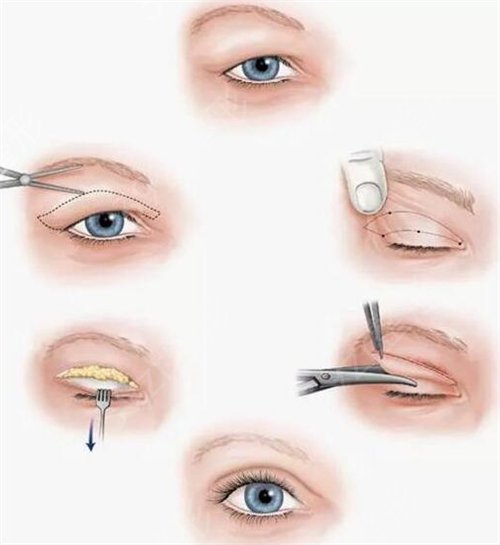 吸雕双眼皮手术亲身体验过程分享【附案例】