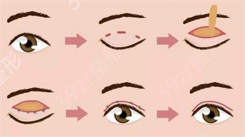 韩式or欧式双眼皮哪个更好?怎么知道自己适合哪个?