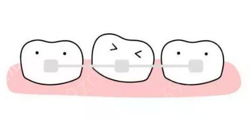 牙缝大能补吗?牙齿稀疏缝大怎么补?