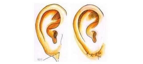 宝宝6种常见畸形耳朵分别是哪些?