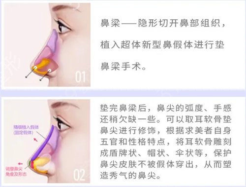 假体隆鼻手术过程【附图】,深刻的术前体会临阵不惧