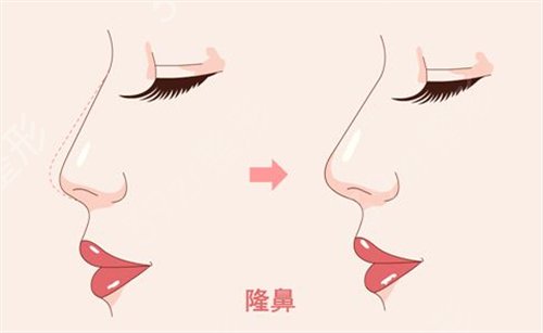 鼻头鼻翼缩小的两种方法介绍,你喜欢哪种?