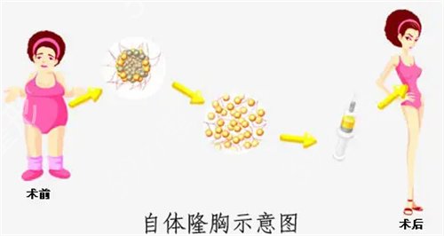 医科大学航空总医院整形美容科自体脂肪隆胸真人案例*果图分享