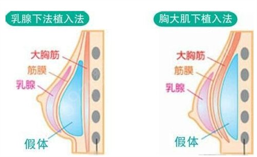 湖南省肿瘤医院整形外科假体隆胸