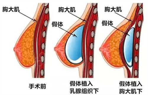 湖南省肿瘤医院整形外科假体隆胸