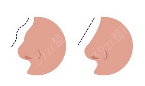 驼峰鼻整形费用