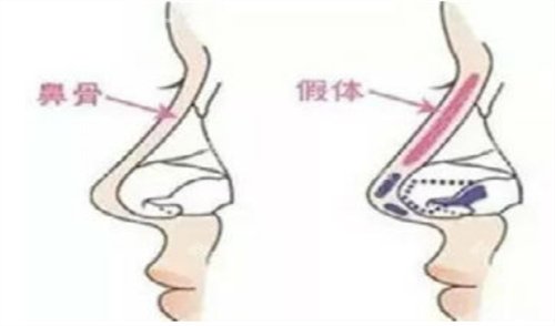 怀化夏韩医疗整形医院价格表全新发布附隆鼻2个月恢复图