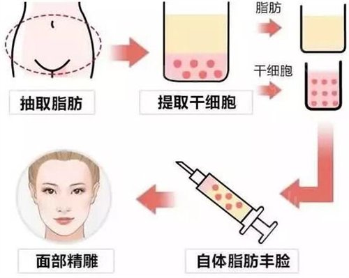 深圳市二医院整形外科脂肪填充面部