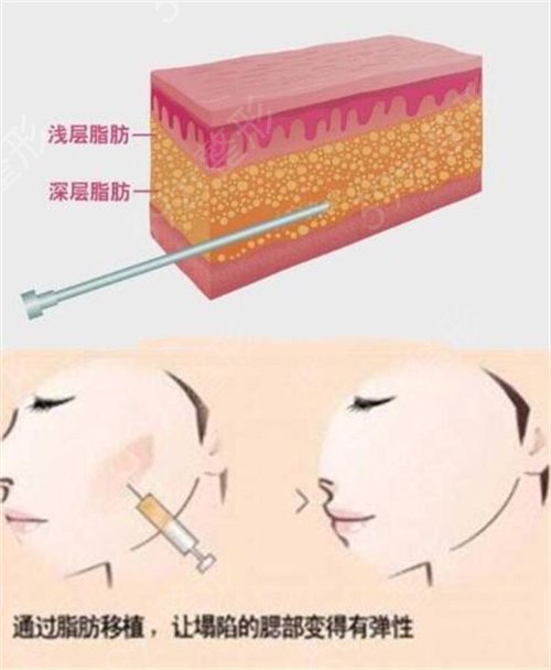 深圳市二医院整形外科脂肪填充面部