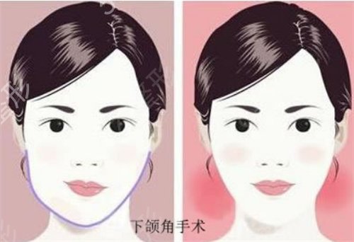 青海省人民医院整形外科价格表2020公布，附下颌角磨骨案例