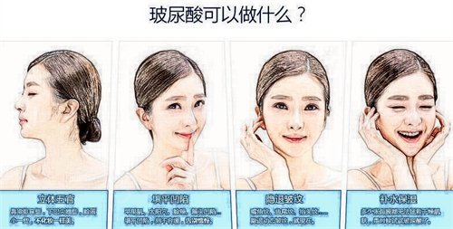 深圳市南山人民医院医疗美容科价格表，附玻尿酸丰脸颊案例