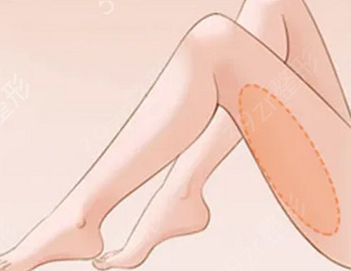 山东省立医院整形科吸脂瘦大腿
